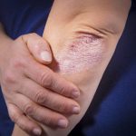 4 conseils pour prendre soin d'une peau atteinte de psoriasis
